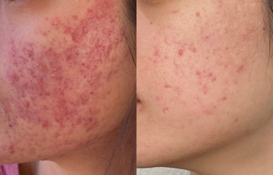 CLEARLY Connected 6-month Acne Program - GLOWDEGA